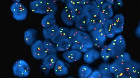 How To Cure Desmoplastic Small Round Cell Tumor (DSRCT) | AllCancer