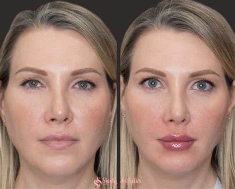 Small Amount Of Lip Filler Before And After - Infoupdate.org