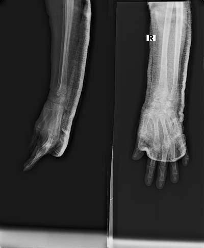 FracAtlas - Dataset Ninja