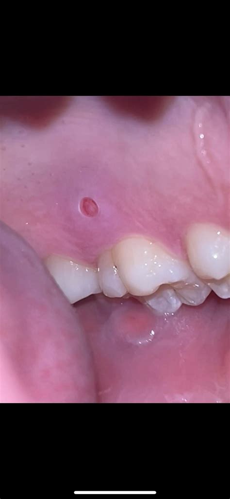 Weird circular cut on gum in mouth : r/DermatologyQuestions