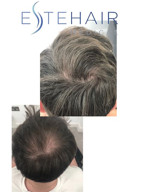 Exosome Hair Loss Treatment - Este Hair Medical