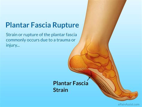 Planters Fasciitis Rupture