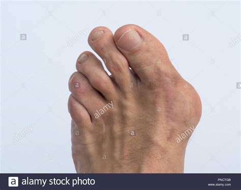 Rheumatoid Arthritis Stock Photos & Rheumatoid Arthritis Stock Images - Alamy