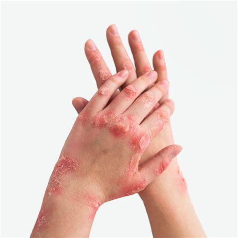 Types of Psoriasis