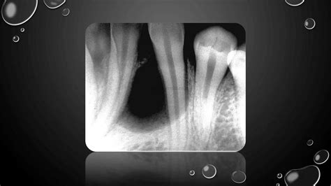 Adenomatoid odontogenic tumor | PPTX