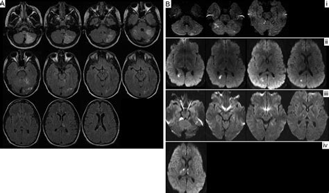Occipital Bone Abnormality Causing Recurrent Posterior Circulation Strokes | Stroke