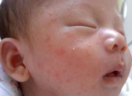 2个月宝宝脸上出现红疹，奶奶扑痱子粉，医生：别乱用_皮肤_孩子_婴儿