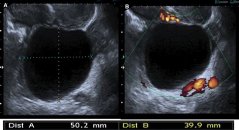 Transvaginal Ultrasound Ovarian Cysts Ovarian Cysts: Functional Or