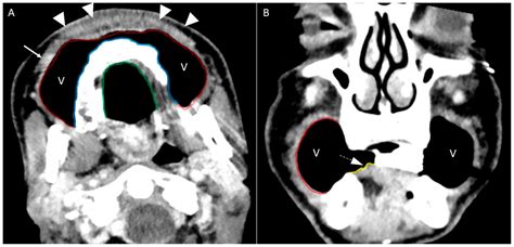 Techniques, Tricks, and Stratagems of Oral Cavity Computed Tomography ...