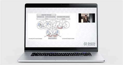 Image result for Spasticity Explained