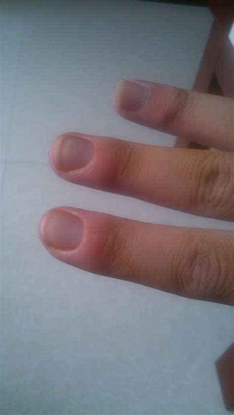 右手前一段时间第五掌骨骨折了，一个月以后拆了石膏。但是右手食指和中指最前面的指节肿的很厉害，啥回事_百度知道