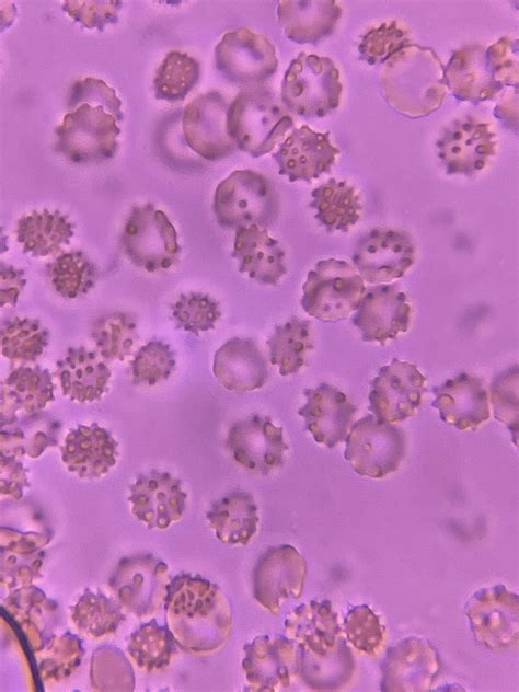 Red Blood Cells And White Blood Cells In Urine