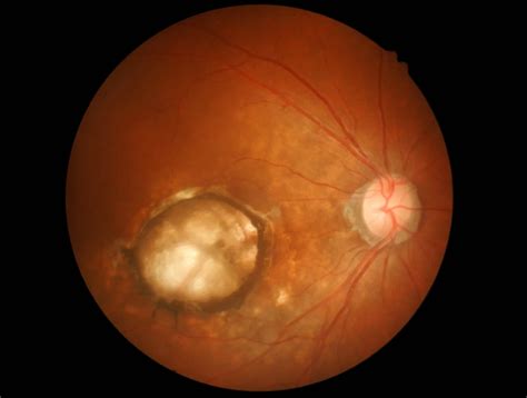 Macular Hole Vision
