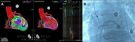 Pulsed-field ablation vs radiofrequency ablation for ventricular ...