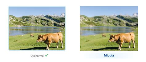 Sintomas De Astigmatismo E Miopia - NAZAEDU