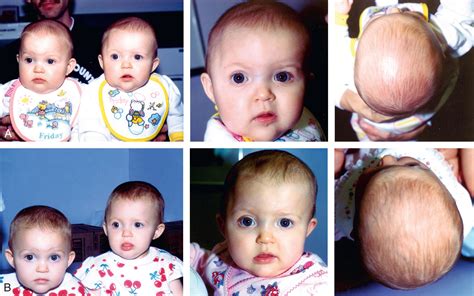Plagiocephaly - Clinical Tree