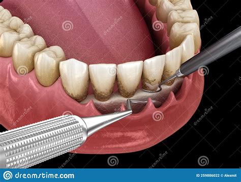Open Curettage: Scaling and Root Planing Conventional Periodontal Therapy. Medically Accurate 3D ...