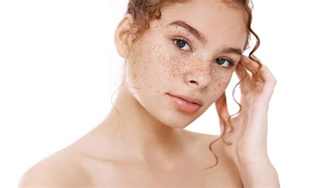 What Causes Freckles? – NutritionFact.in