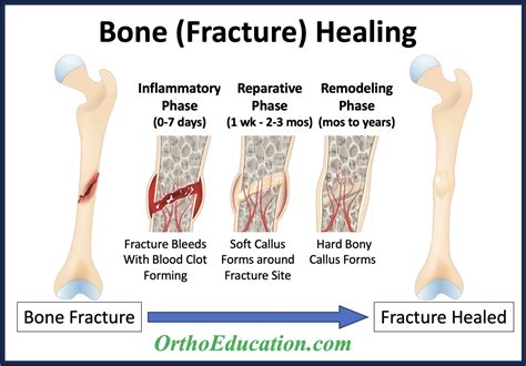 Bone Healing - Fracture Healing - OrthoEducation