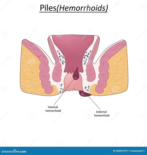Rectum Prolapse. Two Types Of Proctological Disease. Human Anus Cartoon Vector | CartoonDealer ...