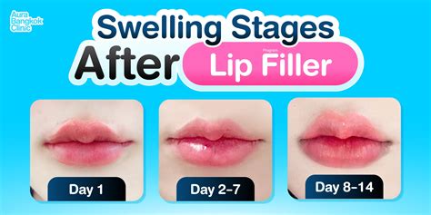 Lip Filler Swelling Stages: Your Complete Healing Guide