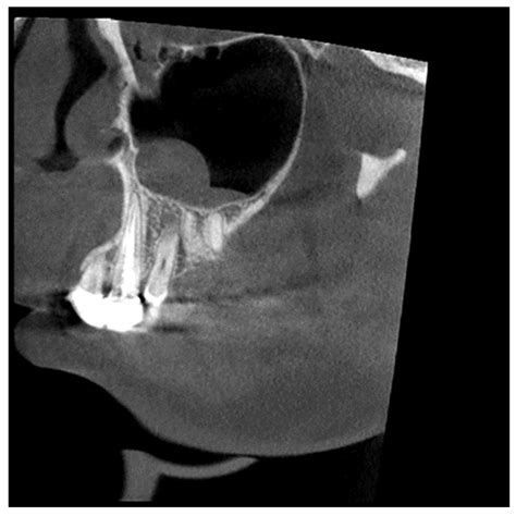 Prevalence of Maxillary Sinus Anomalies on CBCT Scans: A Radiographic ...
