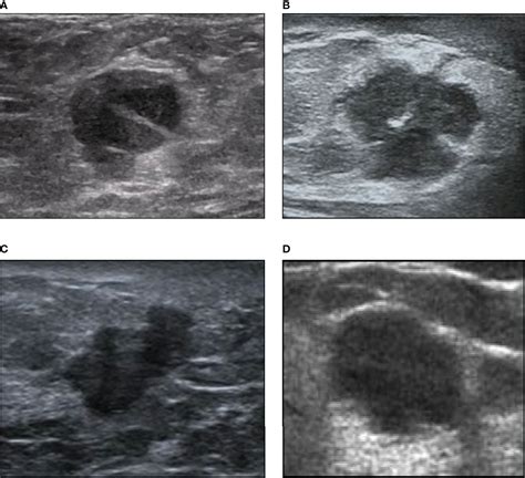 Breast Cancer Malignant Ultrasound Images