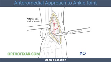 Image result for Ankle Anterolateral Approach Injection