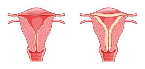 Image result for Hyperplastic Endometrium