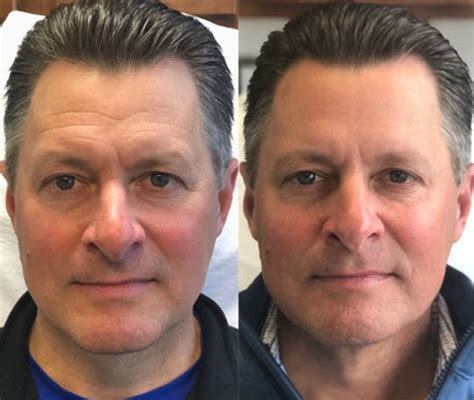 Image result for Common Botox Injections for Men Tutorial