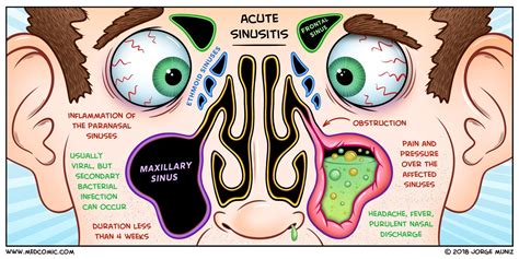 Causas De La Sinusitis – ¿Qué es la Sinusitis Frontal? (Causas, Síntomas y Tratamiento) – FTHCV