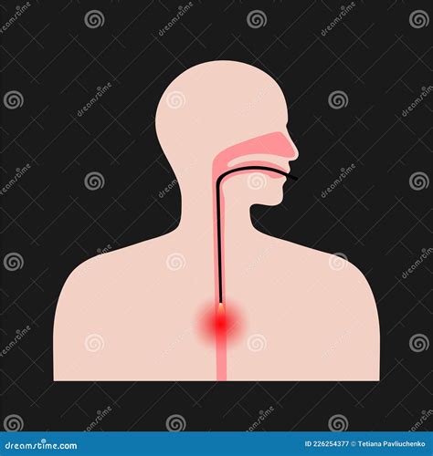 Esophagus Endoscopy Procedure Stock Vector - Illustration of gastric ...
