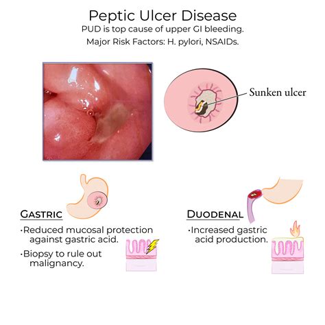 Gastric Ulcer Endoscopy