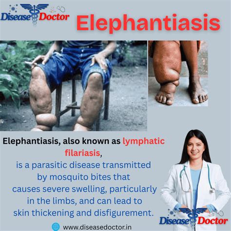 Elephantiasis: 6 Common Causes, 8 Warning Symptoms, and 5 Best ...