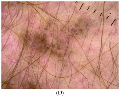 Acanthosis Nigricans: Pointer of Endocrine Entities