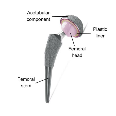 Hip Joint Surgery | Total Hip replacement Surgery - 香港アドベンティスト病院 – スタブスロード