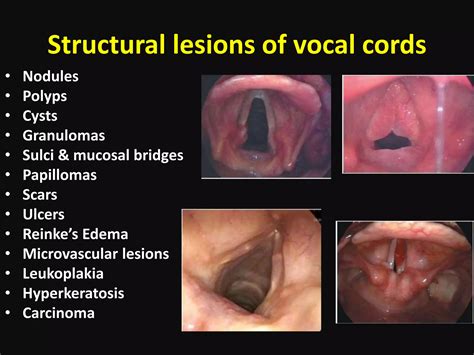 Vocal Cord Granuloma