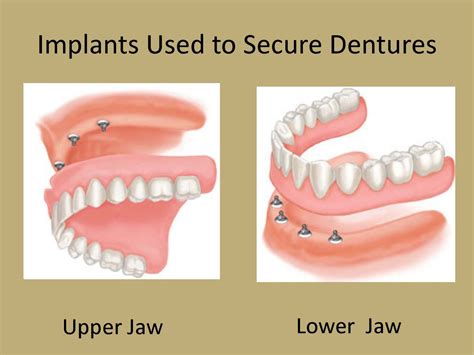 Denture on Implants / implant retained denture - Your Perfect Smile