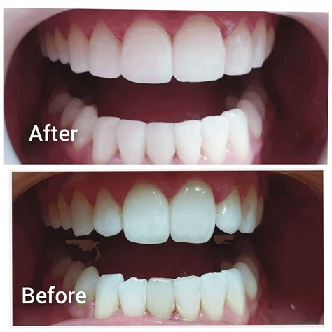 Teeth Bonding – Dentist Grinstead