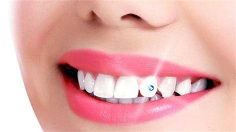 Dental jewelry | Tooth Gems | Smile Centre India