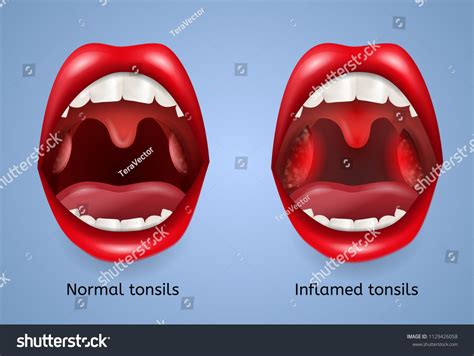 93 Normal tonsil Images, Stock Photos & Vectors | Shutterstock