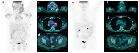 The Role of 18F-FDG PET/CT in Staging and Prognostication of Mantle ...