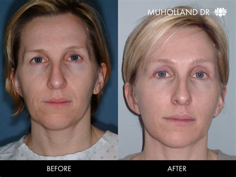 Image result for Thread Lift Procedure YouTube