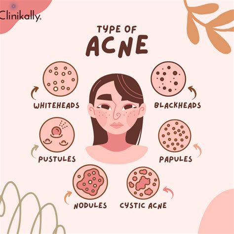 What Your Acne Reveals About Your Overall Health | Clinikally