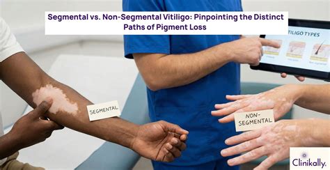 Segmental vs Non-Segmental Vitiligo: Differences & Treatment