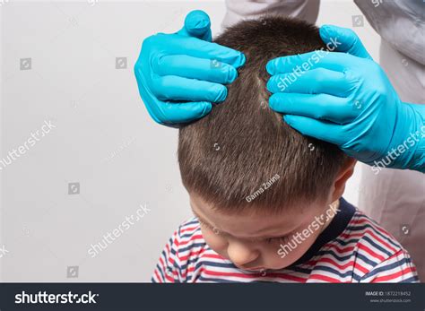 Scalp Parasites 的图像结果