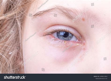 34 Crusty Eyes Baby Royalty-Free Images, Stock Photos & Pictures ...