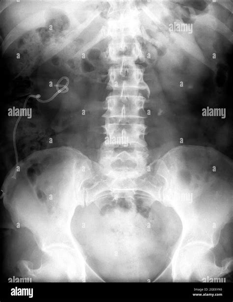 Lumbar Spine Xray