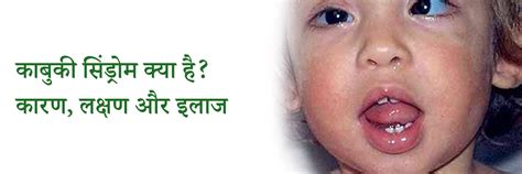 काबुकी सिंड्रोम क्या है? कारण, लक्षण और इलाज | What is Kabuki Syndrome ...