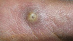 Image result for Jigger Bug Parasite